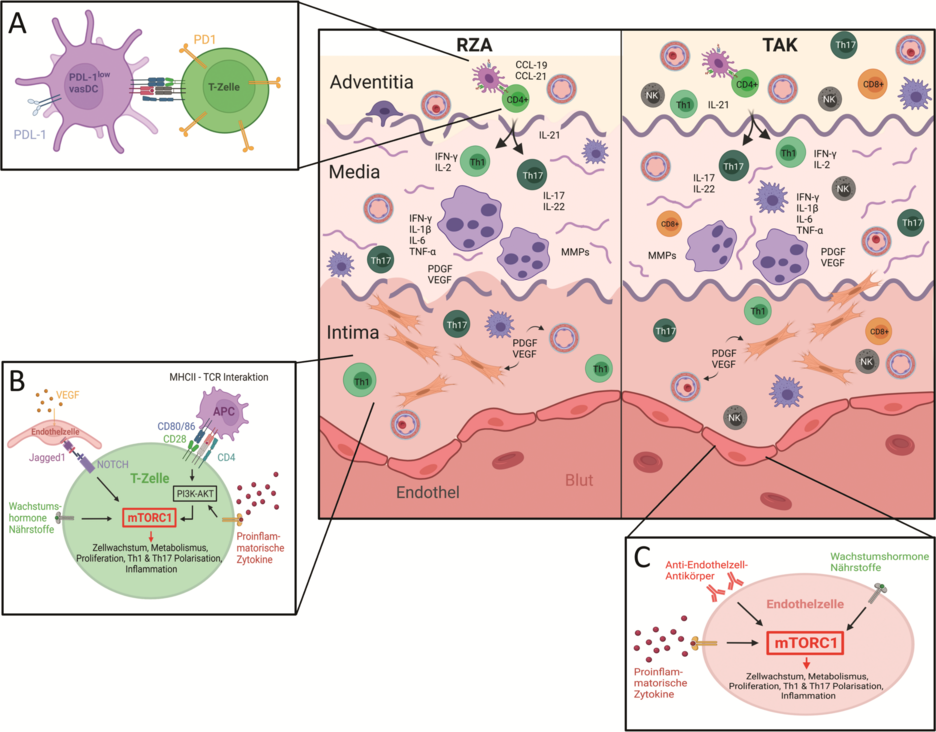 Abbildung 2. Pathogenese der Takayasu-Arteriitis (TAK) und der Riesenzellarteriitis (RZA). Schematische Darstellung der wichtigsten zellulären und humoralen Hauptakteure in der Pathophysiologie der RZA (links) und der TAK (rechts). Bei der RZA und der TAK kommt es zu einer granulomatösen Entzündungsreaktion aller drei Schichten (Adventitia, Media und Intima). Das Entzündungsinfiltrat besteht mehrheitlich aus Th1- und Th17-Zellen, Makrophagen und mehrkernigen Riesenzellen. Bei der TAK kommen zusätzlich CD8+-T-Zellen und NK-Zellen vor, während diese bei RZA nur in geringer Zahl vorhanden sind. Ein weiteres Merkmal der TAK ist die stärkere Beteiligung, Verdickung und Fibrosierung der Adventitia im Vergleich zur RZA. (A) vasDC weisen bei der RZA eine verminderte Expression von PD-L1 auf, wodurch es zu einer reduzierten Inhibition von T-Zellen und folglich zu deren Proliferation und Aktivierung kommt. (B) Pathologische Aktivierung von mTORC1 in T-Zellen von RZA-Patientinnen und -Patienten über den CD28-PI3K-AKT-Signalweg sowie über die VEGF-Jagged1-NOTCH-Achse. (C) Pathologische mTORC1-Aktivierung in Endothelzellen bei TAK vermittelt durch Anti-Endothelzell-Antikörper.