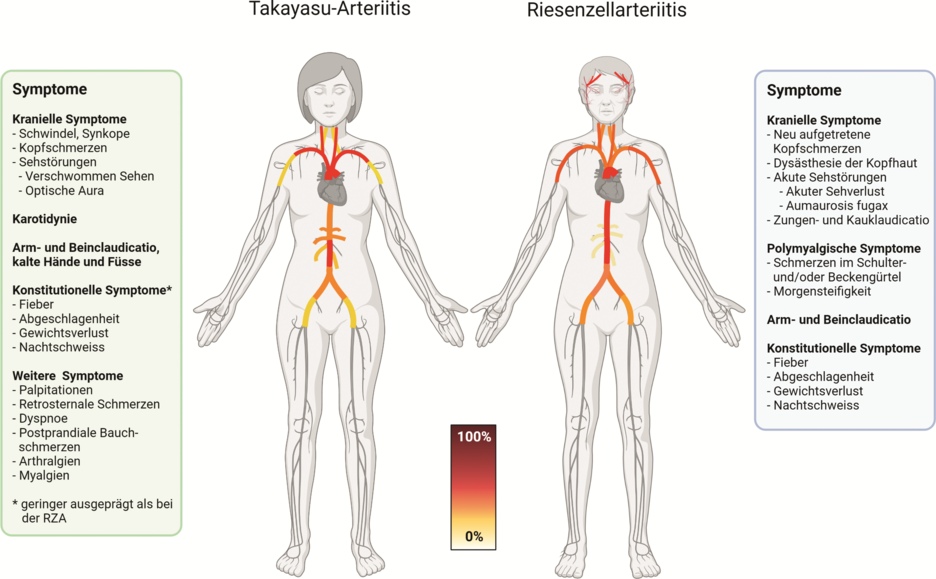 Abbildung 1. Symptome der Takayasu-Arteriitis und Riesenzellarteriitis sowie farbliche Darstellung der potenziell befallenen Gefässabschnitte mit ungefährer Häufigkeit des Befalls.