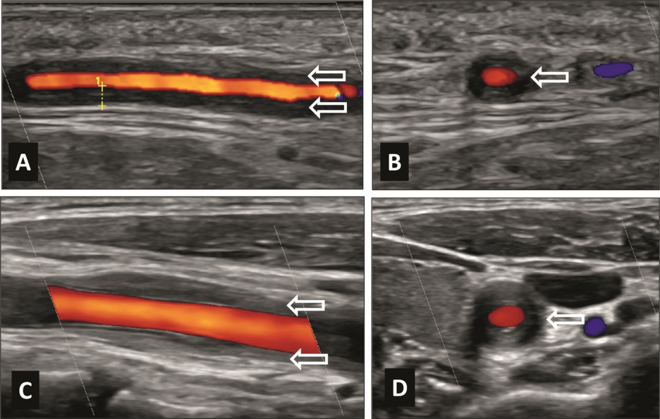 Abbildung 3. A: Arteria temporalis superficialis communis bei neu diagnostizierter RZA Longitudinalschnitt: Intima-Media Dicke: 0,75 mm; B: gleiches Gefäss im Transversalschnitt; C: Arteria carotis communis bei Takayasu-Arteriitis Longitudinalschnitt; D: gleiches Gefäss im Transversalschnitt; Pfeil: Halo-Zeichen (entzündliche Wandschwellung). Bild wurde von Prof. Dr. med. Wolfgang Schmidt, Immanuel Krankenhaus in Berlin, zur Verfügung gestellt.