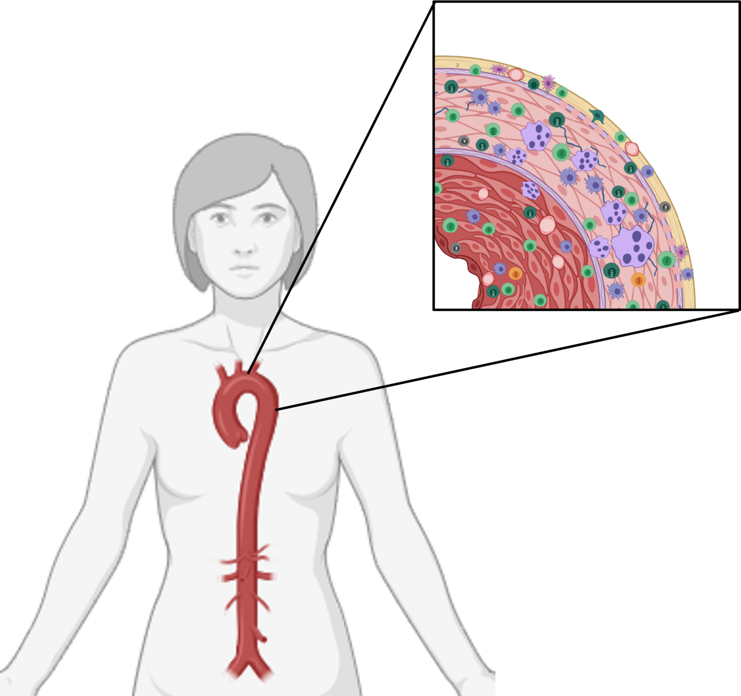 Entzündungen in der Gefässwand können sowohl bei der Riesenzellarteriitis als auch bei der Takayasu-Arteriitis zu einer verminderten Durchblutung führen. Bild: Andrea Gloor