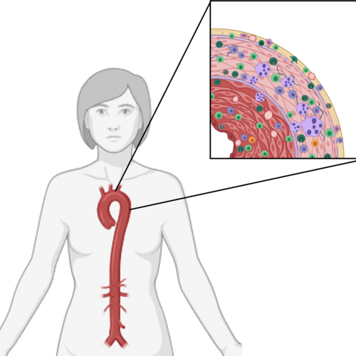 Entzündungen in der Gefässwand können sowohl bei der Riesenzellarteriitis als auch bei der Takayasu-Arteriitis zu einer verminderten Durchblutung führen. Bild: Andrea Gloor