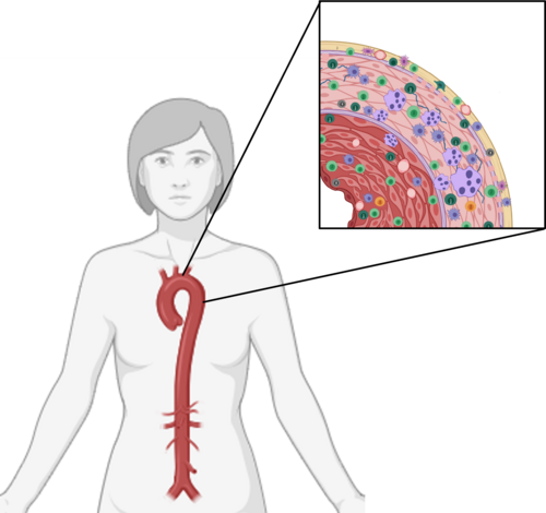 Entzündungen in der Gefässwand können sowohl bei der Riesenzellarteriitis als auch bei der Takayasu-Arteriitis zu einer verminderten Durchblutung führen. Bild: Andrea Gloor