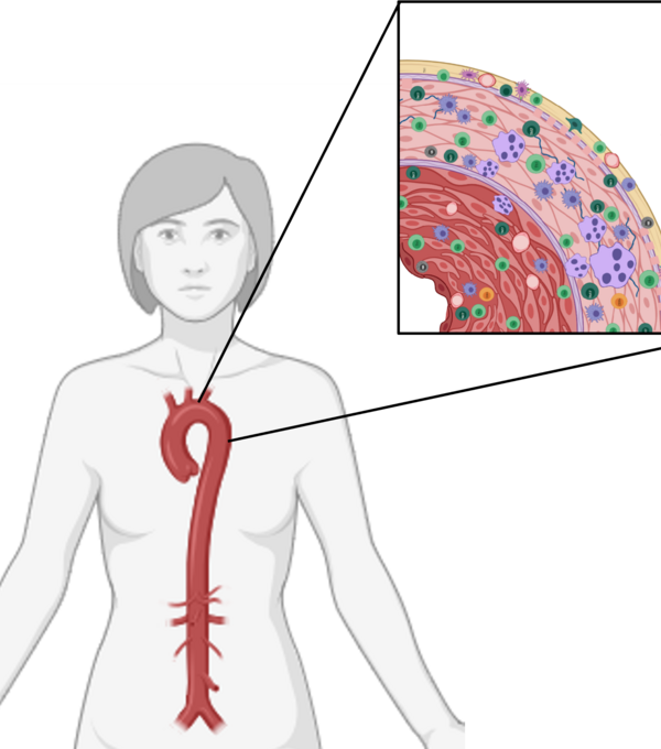 Entzündungen in der Gefässwand können sowohl bei der Riesenzellarteriitis als auch bei der Takayasu-Arteriitis zu einer verminderten Durchblutung führen. Bild: Andrea Gloor