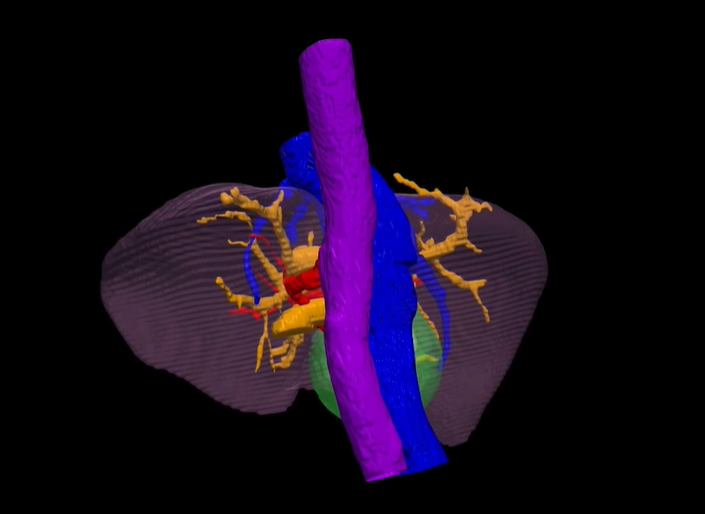 Une opération sur le foie numérique, qui renseigne sur la fonction hépatique restante, peut être simulée avant de la réaliser sur la personne concernée. Photo: Siemens Healthineers